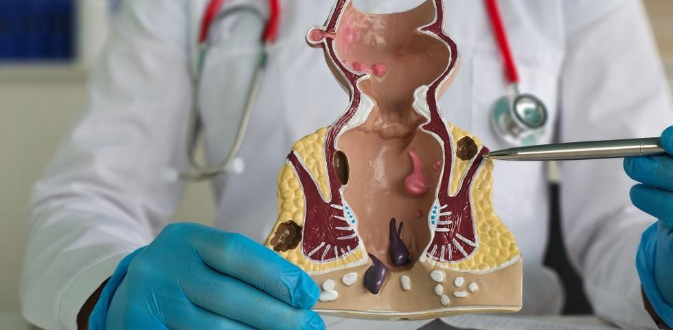 Hernia and rectal prolapse